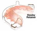 hawley-retainer-2 hawley-retainer-2