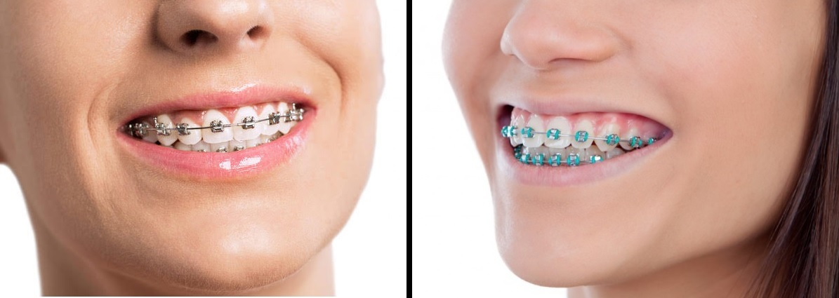 Image result for self ligating vs conventional braces